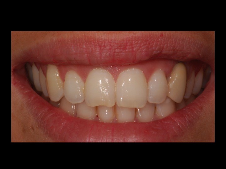 caso_periodoncia_1g_clinica dental barcelona SYP