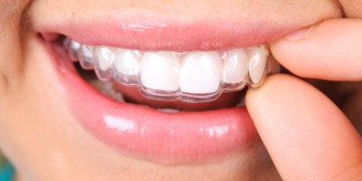 Orthodontics Invisalign - Dentist in Barcelona  Sanz&Pancko