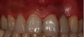 Estética gingival tratamientos - Clínica Dental Sanz&Pancko Barcelona