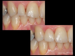 Carillas de composite: espacios entre dientes