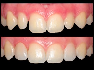 Carillas de composite: espacios entre dientes -2